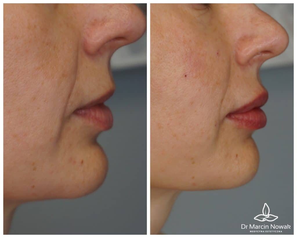 Metamorfoza Eigenfett-Transplantation (Lipofilling)