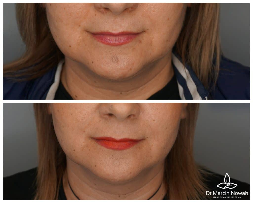 Metamorfoza Gesichtsoval-Modellierung & Lifting