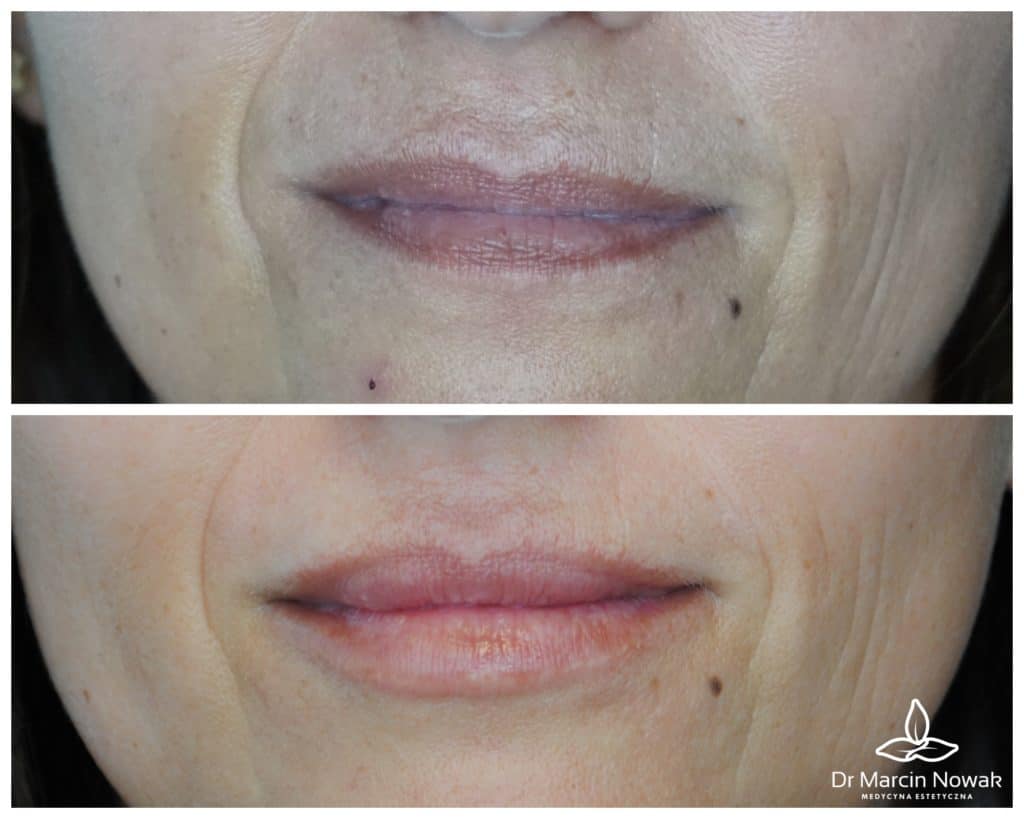 Metamorfoza Lippenmodellierung & Hydratisierung
