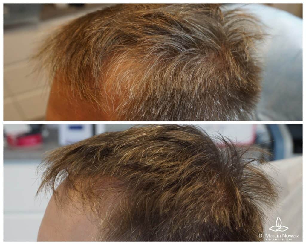 Metamorfoza Regenera Activa (Haarausfall-Stammzelltherapie)