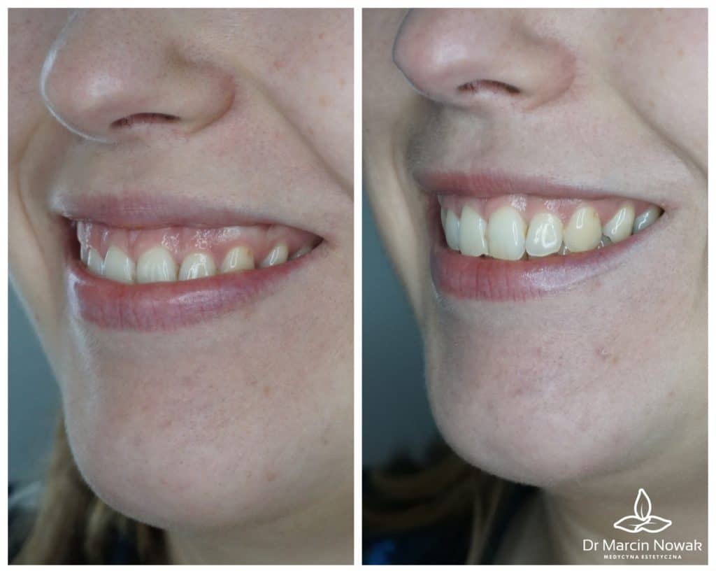 Metamorfoza Gummy Smile Korrektur (Zahnfleischlächeln)