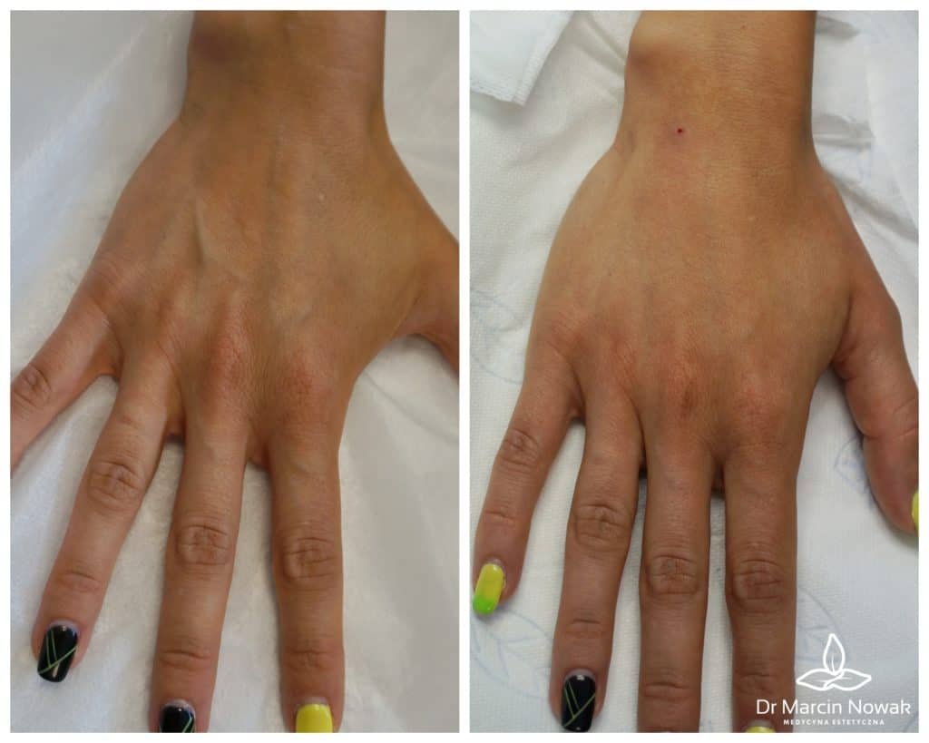 Metamorfoza Handverjüngung & Volumenaufbau