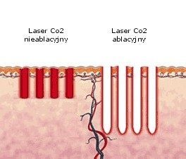 Фракційний CO2 лазер — золотий стандарт у лікуванні рубців та розтяжок