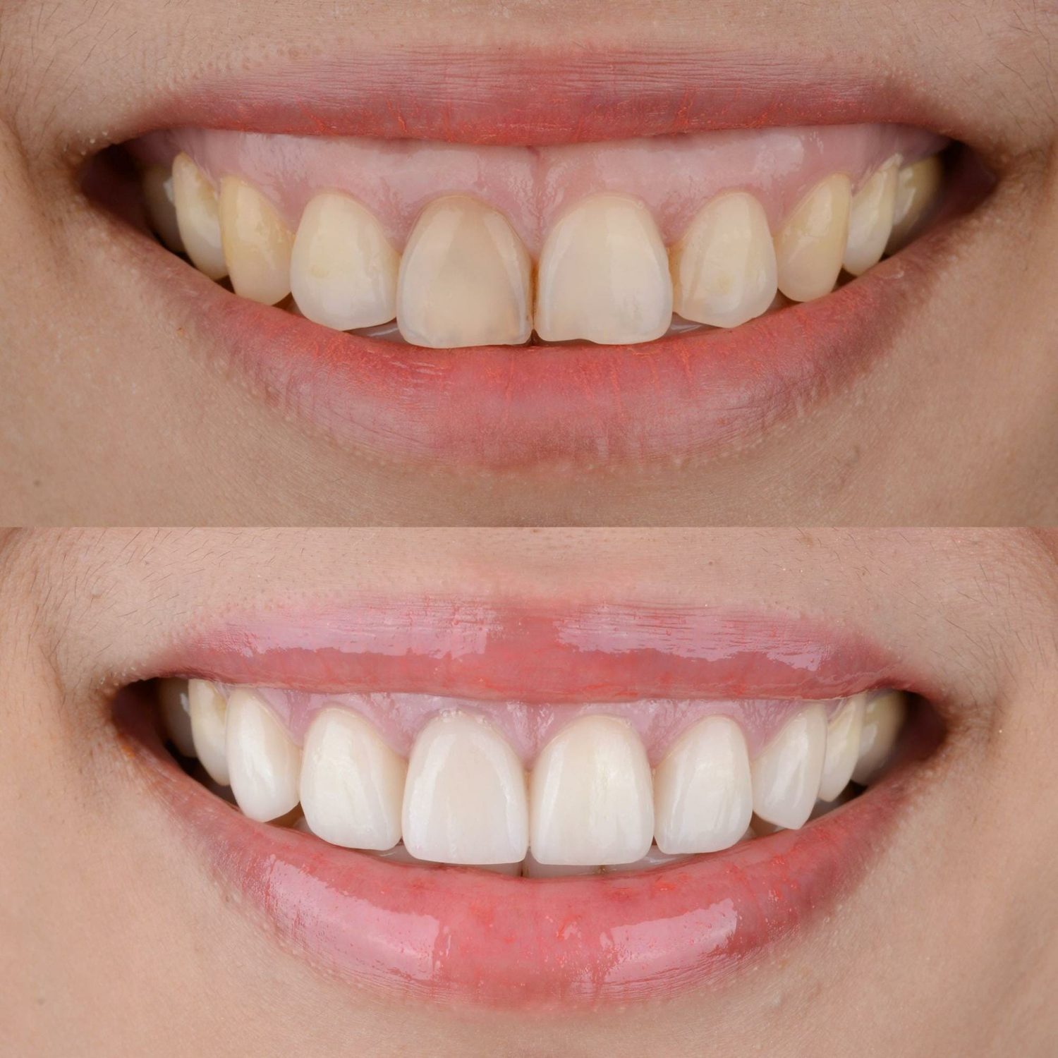 Korekcja uśmiechu dziąsłowego – Gummy Smile Gdańsk - Zabieg Medycyny Estetycznej dr Marcin Nowak